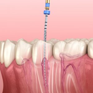 Root Canal